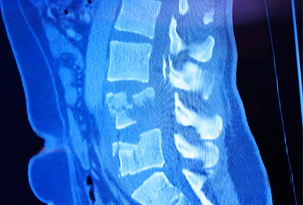 Bei verschleißbedingten Wirbelbrüchen, z. B. aufgrund einer Osteoporose, kann eine Operation helfen, die Beweglichkeit zu erhalten oder wiederherzustellen. Bei verschleißbedingten Wirbelbrüchen, z. B. aufgrund einer Osteoporose, kann eine Operation helfen, die Beweglichkeit zu erhalten oder wiederherzustellen.